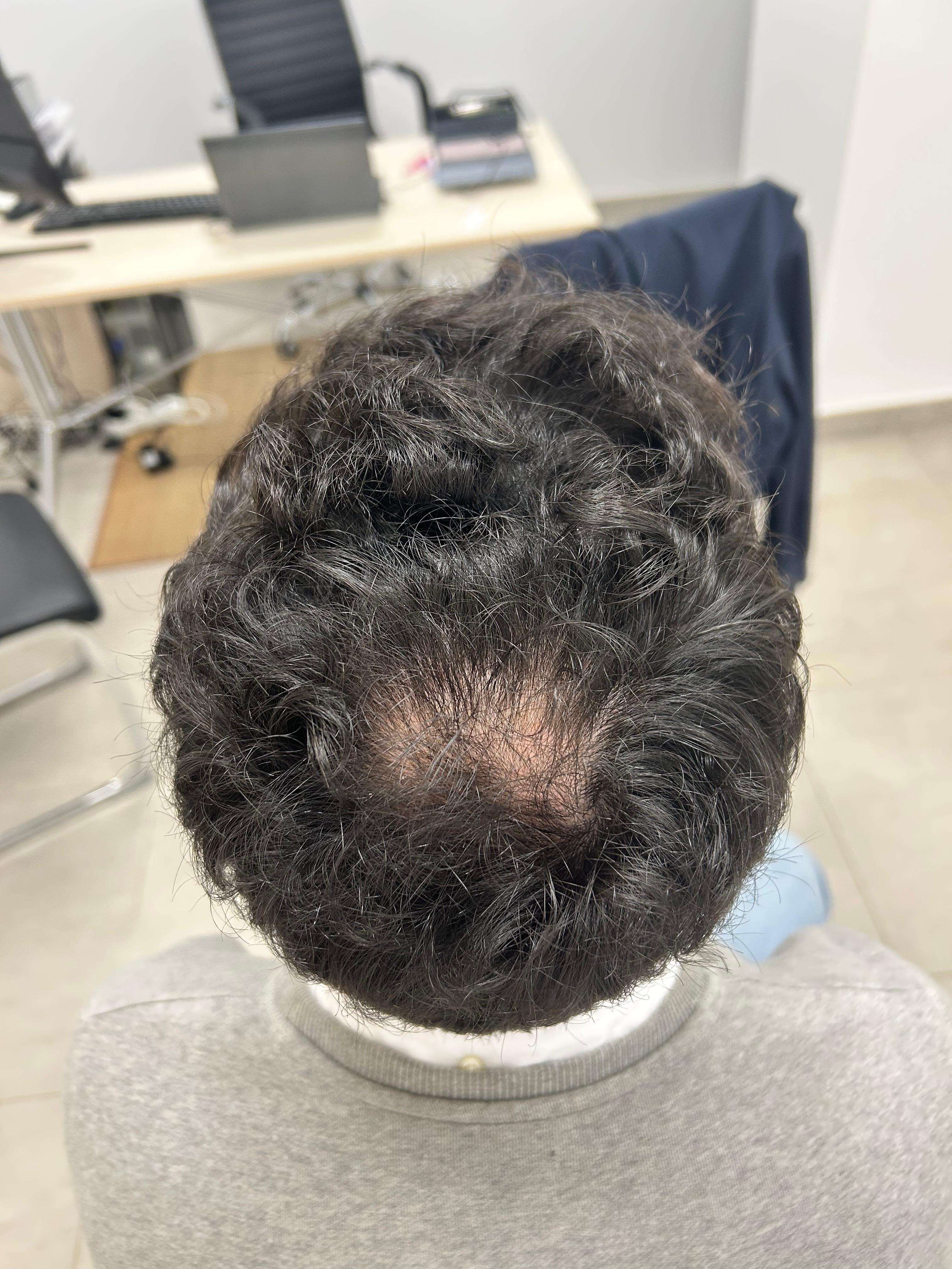 Antes del tratamiento · Caso 2